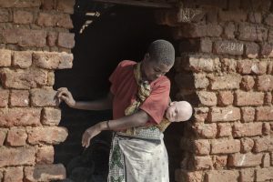 Ébano y marfil: la persecución del albinismo en África
